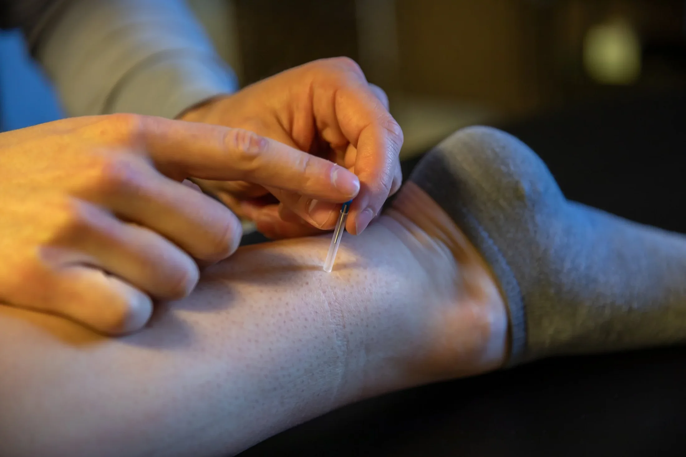 Bridge physical therapist performing dry needling treatment